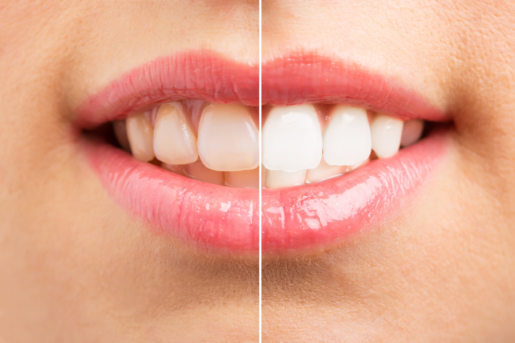 Teeth Whitening or Veneers: Which Gives a Brighter Result?